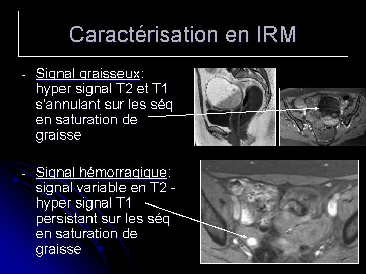 Caractérisation en IRM - Signal graisseux: hyper signal T 2 et T 1 s’annulant