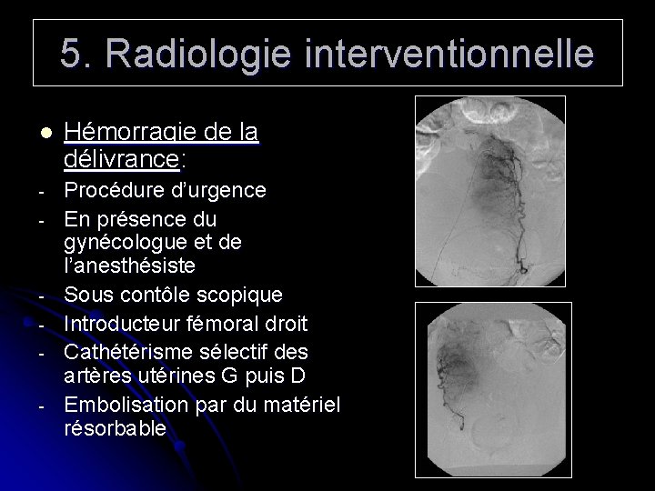 5. Radiologie interventionnelle l Hémorragie de la délivrance: - Procédure d’urgence En présence du