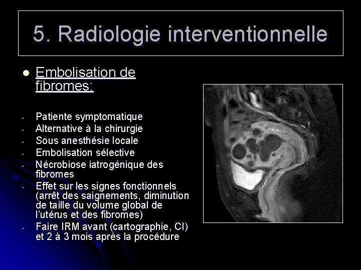 5. Radiologie interventionnelle l Embolisation de fibromes: - Patiente symptomatique Alternative à la chirurgie