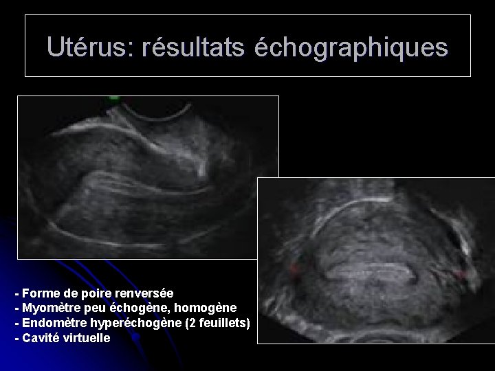 Utérus: résultats échographiques - Forme de poire renversée - Myomètre peu échogène, homogène -