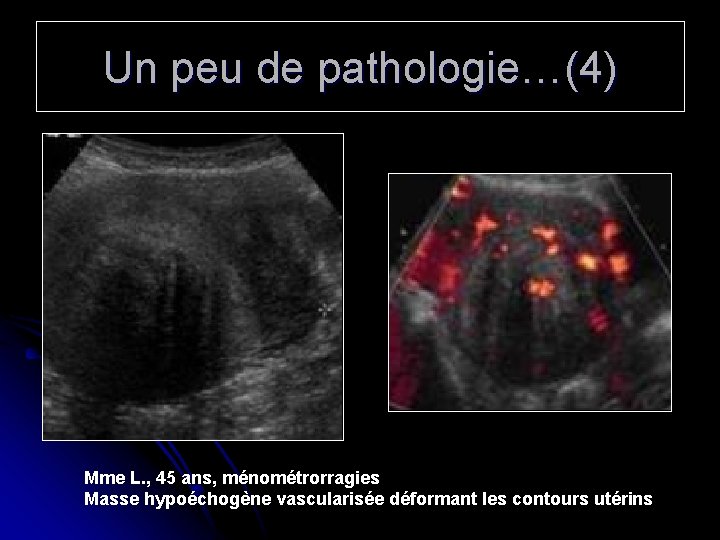 Un peu de pathologie…(4) Mme L. , 45 ans, ménométrorragies Masse hypoéchogène vascularisée déformant