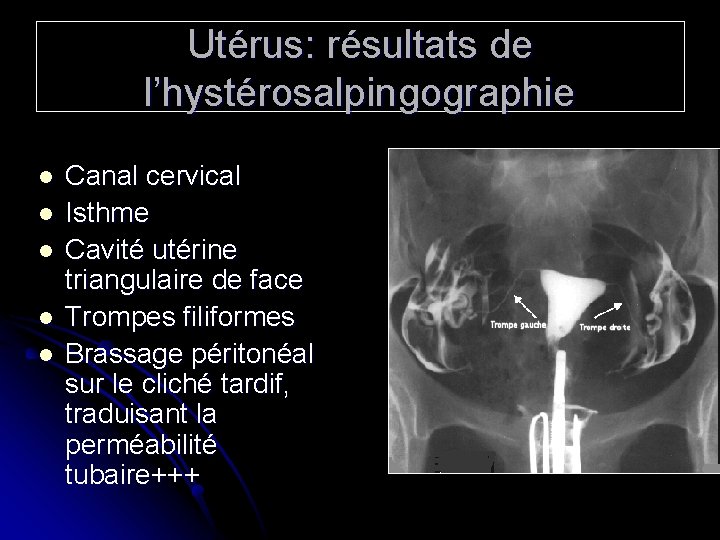 Utérus: résultats de l’hystérosalpingographie l l l Canal cervical Isthme Cavité utérine triangulaire de