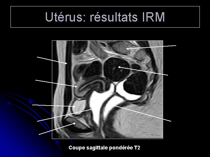 Utérus: résultats IRM Coupe sagittale pondérée T 2 