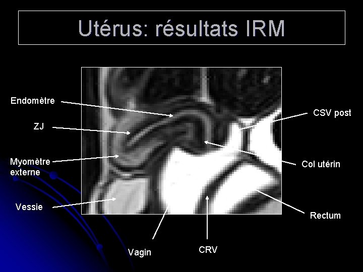 Utérus: résultats IRM Endomètre CSV post ZJ Myomètre externe Col utérin Vessie Rectum Vagin