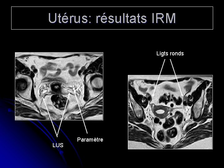 Utérus: résultats IRM Ligts ronds LUS Paramètre 