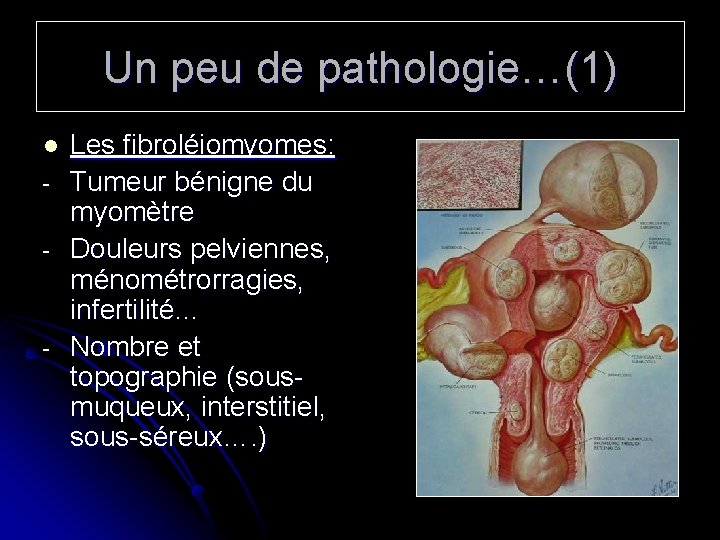 Un peu de pathologie…(1) l - - Les fibroléiomyomes: Tumeur bénigne du myomètre Douleurs