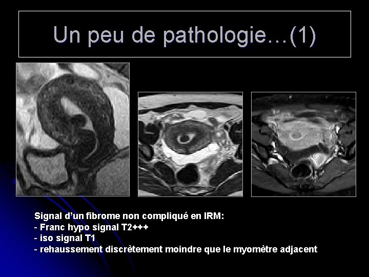Un peu de pathologie…(1) Signal d’un fibrome non compliqué en IRM: - Franc hypo