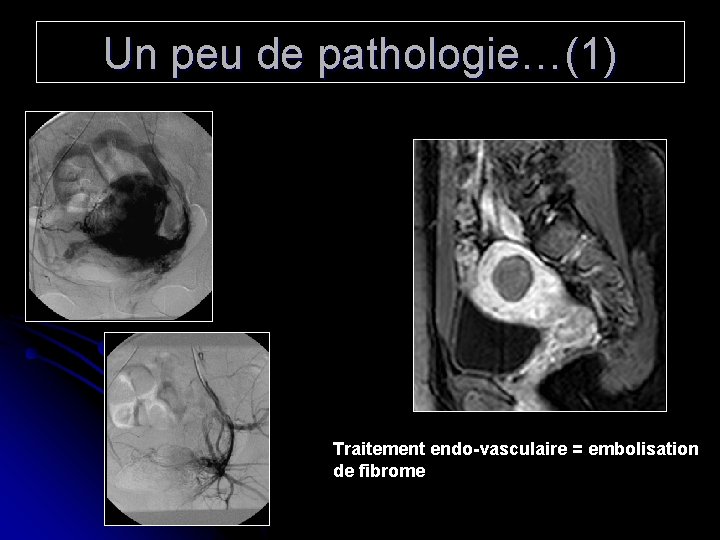Un peu de pathologie…(1) Traitement endo-vasculaire = embolisation de fibrome 