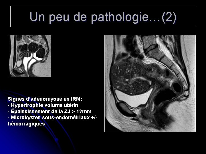 Un peu de pathologie…(2) Signes d’adénomyose en IRM: - Hypertrophie volume utérin - Épaississement