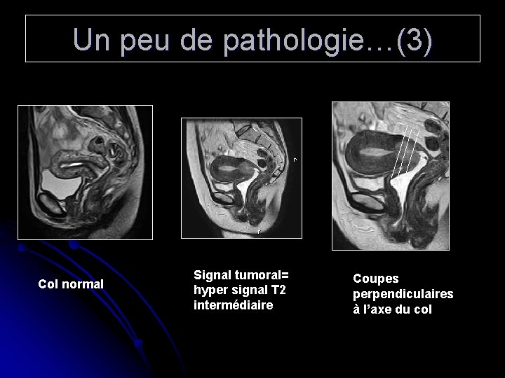 Un peu de pathologie…(3) Col normal Signal tumoral= hyper signal T 2 intermédiaire Coupes