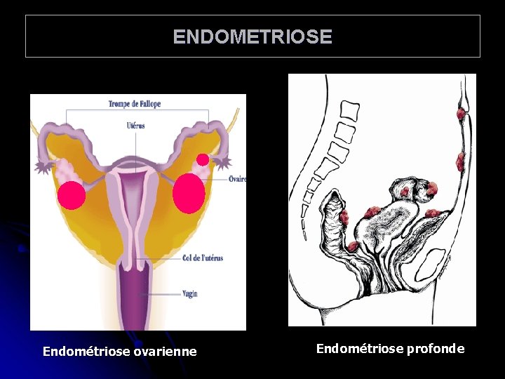 ENDOMETRIOSE Endométriose ovarienne Endométriose profonde 