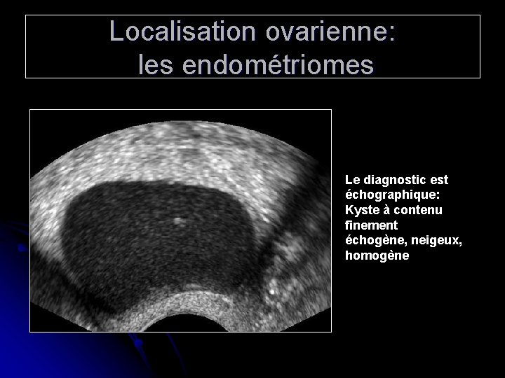 Localisation ovarienne: les endométriomes Le diagnostic est échographique: Kyste à contenu finement échogène, neigeux,