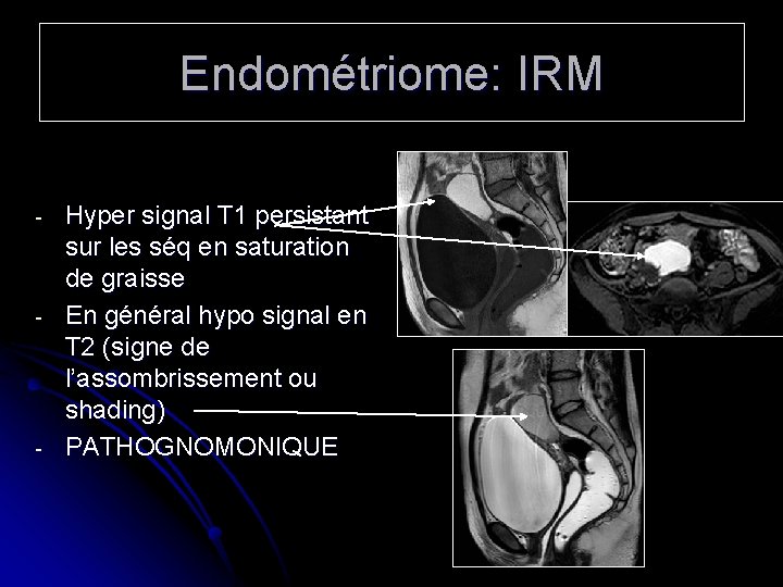 Endométriome: IRM - - - Hyper signal T 1 persistant sur les séq en