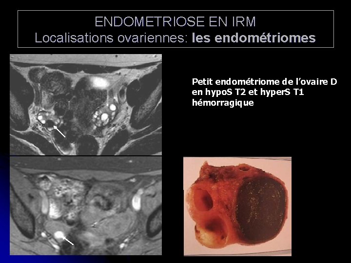 ENDOMETRIOSE EN IRM Localisations ovariennes: les endométriomes Petit endométriome de l’ovaire D en hypo.