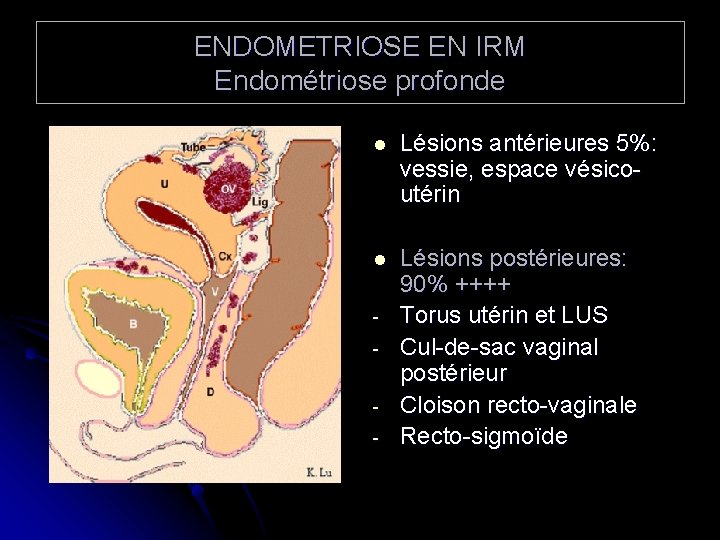 ENDOMETRIOSE EN IRM Endométriose profonde l Lésions antérieures 5%: vessie, espace vésicoutérin l Lésions