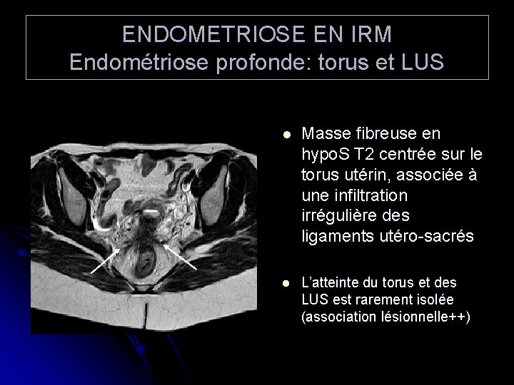 ENDOMETRIOSE EN IRM Endométriose profonde: torus et LUS l Masse fibreuse en hypo. S