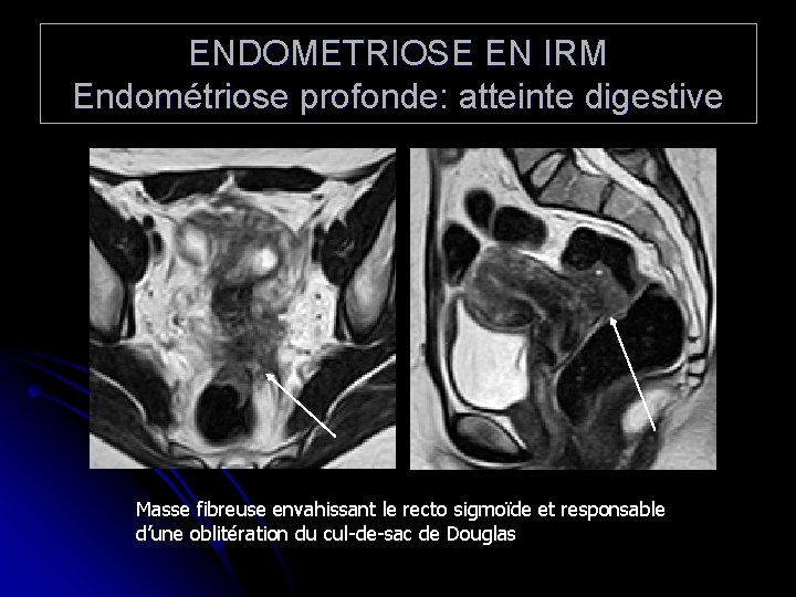 ENDOMETRIOSE EN IRM Endométriose profonde: atteinte digestive Masse fibreuse envahissant le recto sigmoïde et