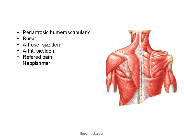  • • • Periartrosis humeroscapularis Bursit Artrose, sjælden Artrit, sjælden Refered pain Neoplasmer
