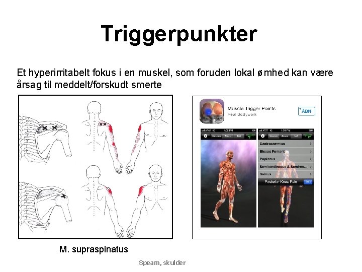 Triggerpunkter Et hyperirritabelt fokus i en muskel, som foruden lokal ømhed kan være årsag