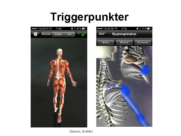 Triggerpunkter Speam, skulder 