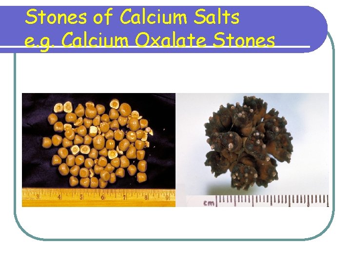 Stones of Calcium Salts e. g. Calcium Oxalate Stones Stones of Calcium Salts e. g. Calcium Oxalate Stones
