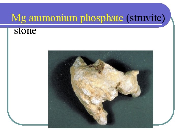 Mg ammonium phosphate (struvite) stone Mg ammonium phosphate (struvite) stone