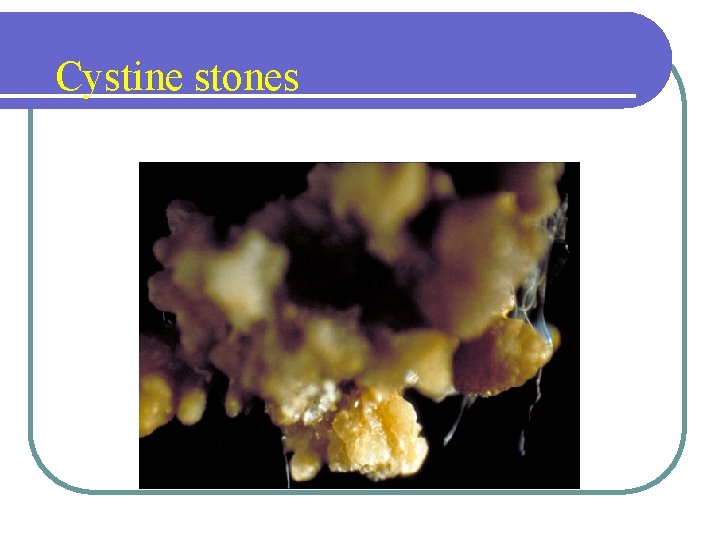 Cystine stones Cystine stones