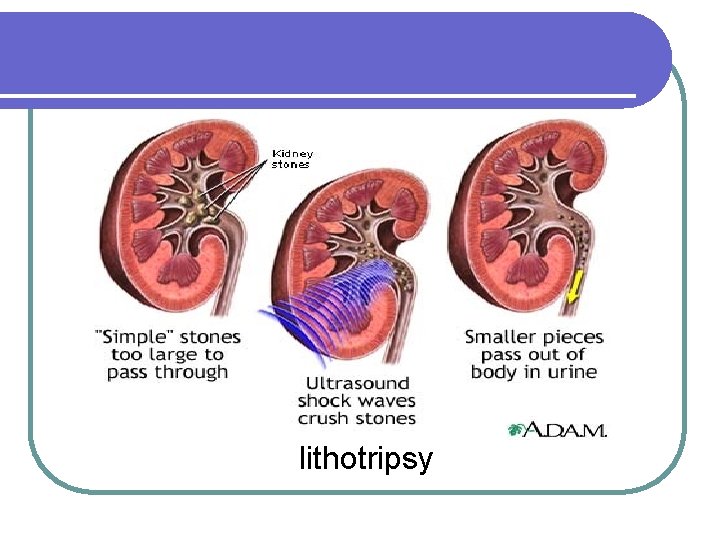 lithotripsy lithotripsy