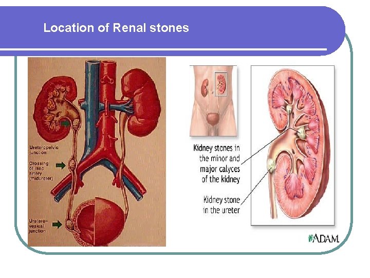 Location of Renal stones Location of Renal stones