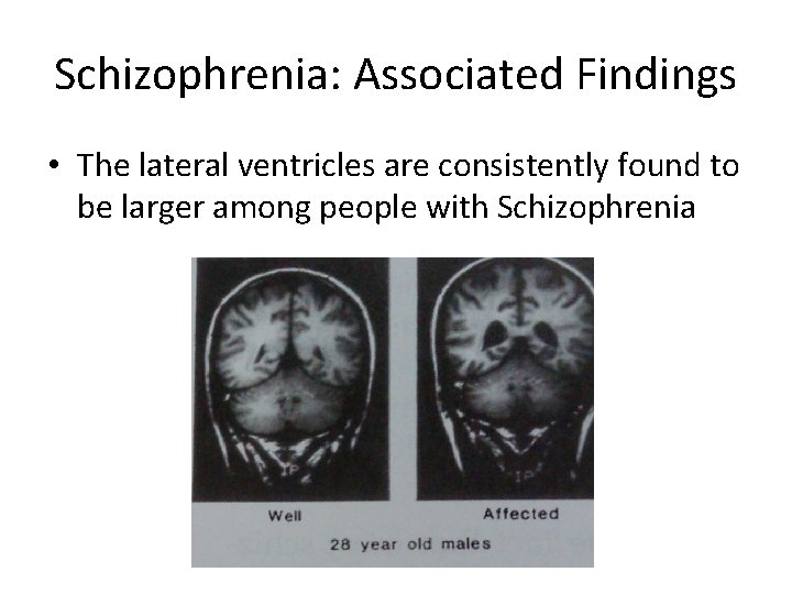 Schizophrenia: Associated Findings • The lateral ventricles are consistently found to be larger among