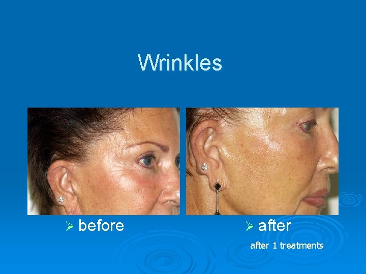 Wrinkles Ø before Ø after 1 treatments 