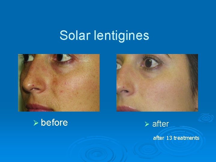 Solar lentigines Ø before Ø after 13 treatments 