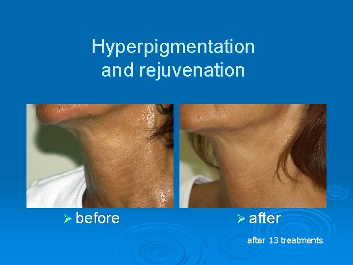 Hyperpigmentation and rejuvenation Ø before Ø after 13 treatments 