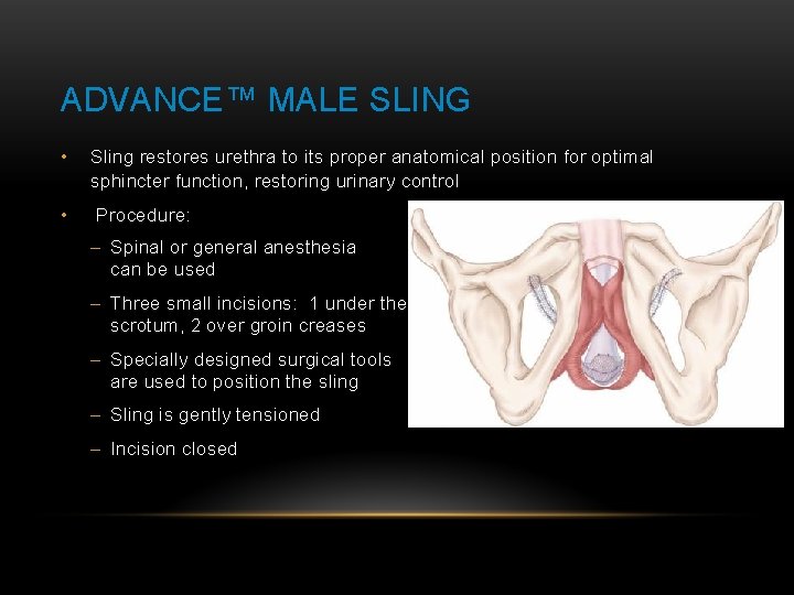 ADVANCE™ MALE SLING • Sling restores urethra to its proper anatomical position for optimal