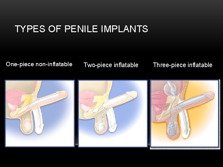 TYPES OF PENILE IMPLANTS One-piece non-inflatable Two-piece inflatable Three-piece inflatable 