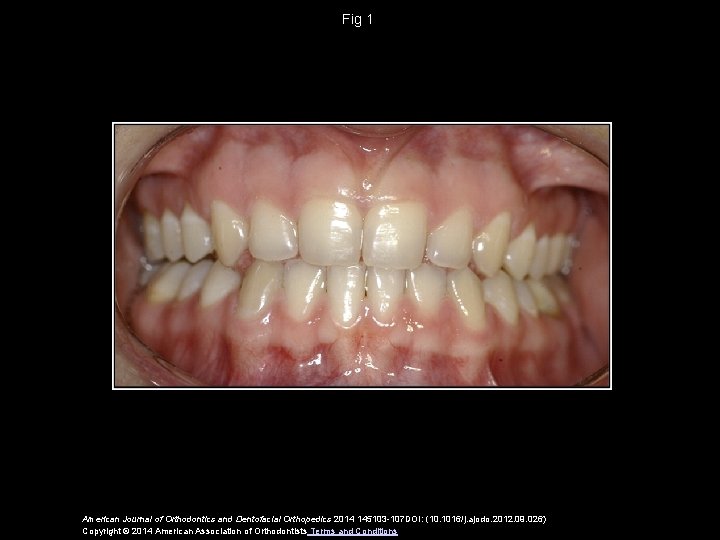 Fig 1 American Journal of Orthodontics and Dentofacial Orthopedics 2014 145103 -107 DOI: (10.