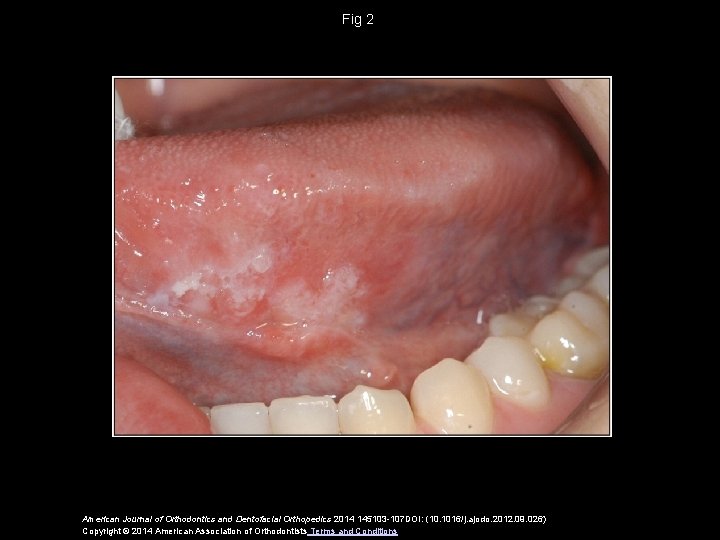 Fig 2 American Journal of Orthodontics and Dentofacial Orthopedics 2014 145103 -107 DOI: (10.