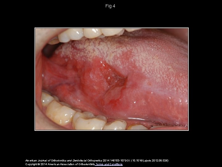 Fig 4 American Journal of Orthodontics and Dentofacial Orthopedics 2014 145103 -107 DOI: (10.