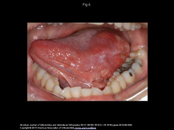 Fig 6 American Journal of Orthodontics and Dentofacial Orthopedics 2014 145103 -107 DOI: (10.