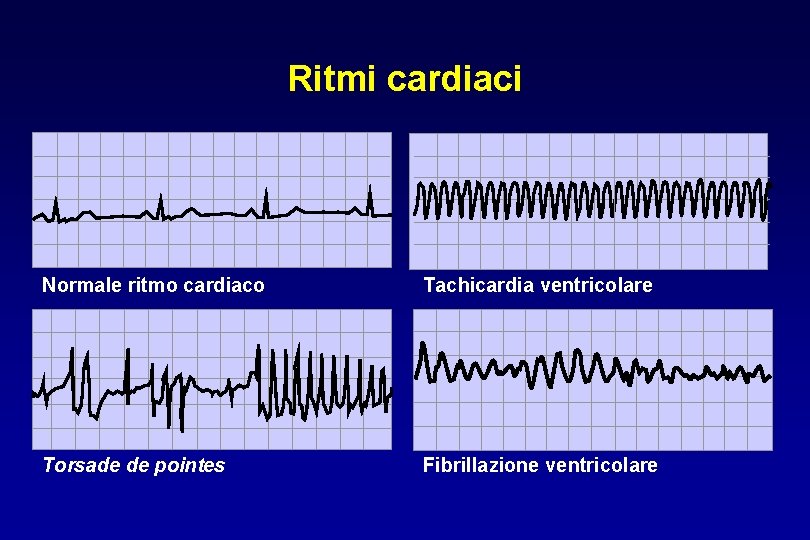 Ritmi cardiaci Normale ritmo cardiaco Tachicardia ventricolare Torsade de pointes Fibrillazione ventricolare 