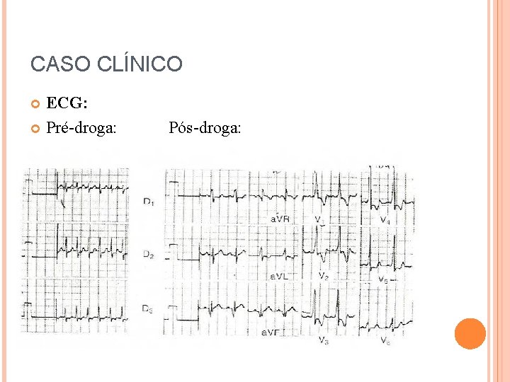 CASO CLÍNICO ECG: Pré-droga: Pós-droga: 