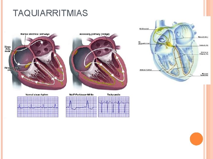 TAQUIARRITMIAS 