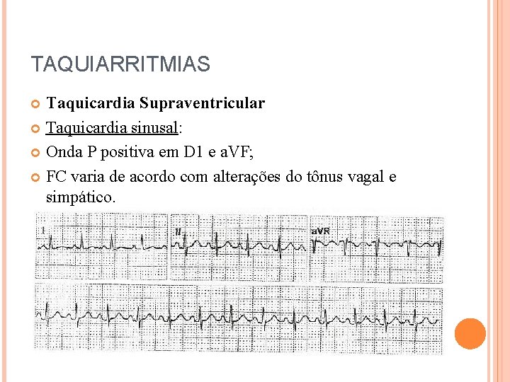 TAQUIARRITMIAS Taquicardia Supraventricular Taquicardia sinusal: Onda P positiva em D 1 e a. VF;