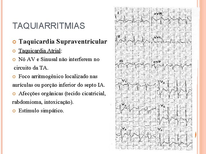 TAQUIARRITMIAS Taquicardia Supraventricular Taquicardia Atrial: Nó AV e Sinusal não interferem no circuito da