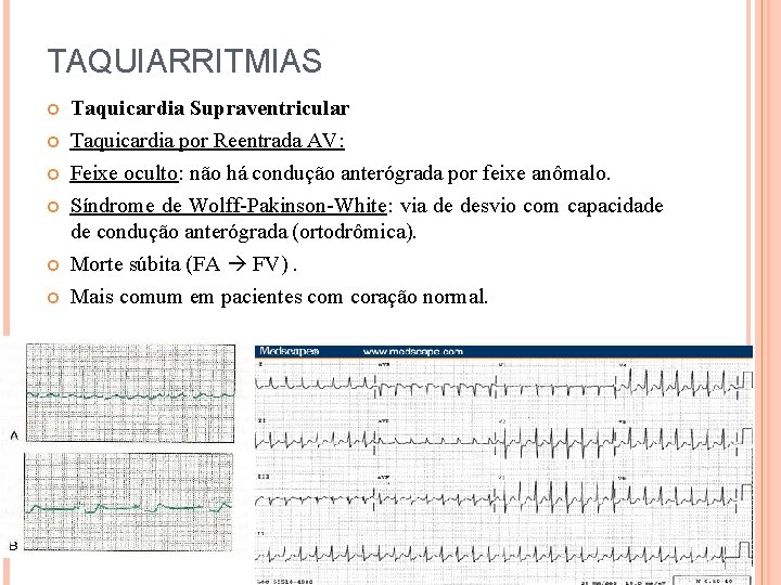 TAQUIARRITMIAS Taquicardia Supraventricular Taquicardia por Reentrada AV: Feixe oculto: não há condução anterógrada por