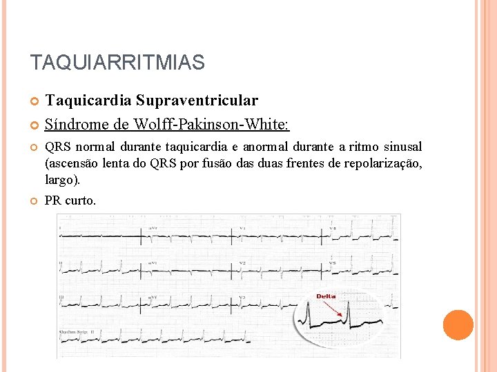 TAQUIARRITMIAS Taquicardia Supraventricular Síndrome de Wolff-Pakinson-White: QRS normal durante taquicardia e anormal durante a