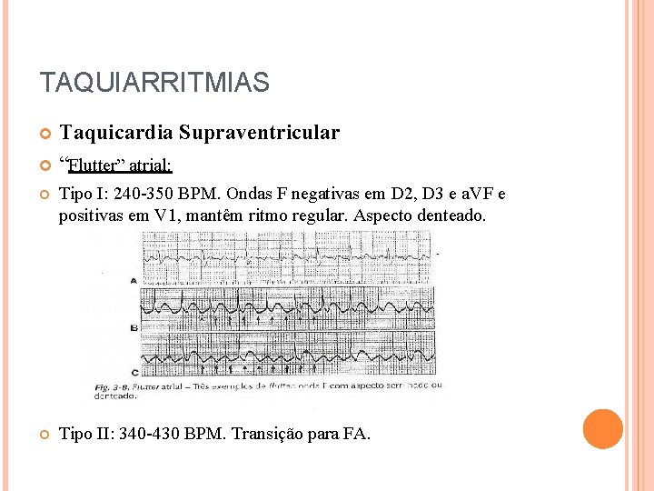 TAQUIARRITMIAS Taquicardia Supraventricular “Flutter” atrial: Tipo I: 240 -350 BPM. Ondas F negativas em