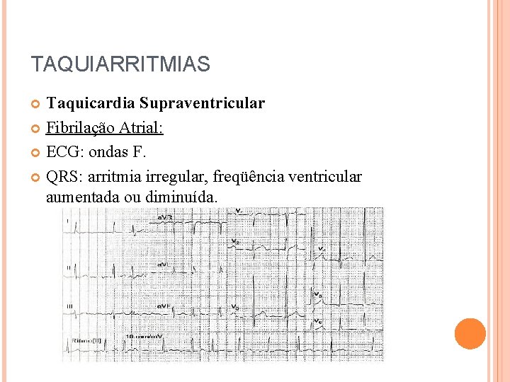 TAQUIARRITMIAS Taquicardia Supraventricular Fibrilação Atrial: ECG: ondas F. QRS: arritmia irregular, freqüência ventricular aumentada