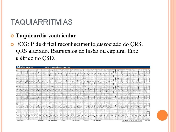 TAQUIARRITMIAS Taquicardia ventricular ECG: P de difícil reconhecimento, dissociado do QRS alterado. Batimentos de