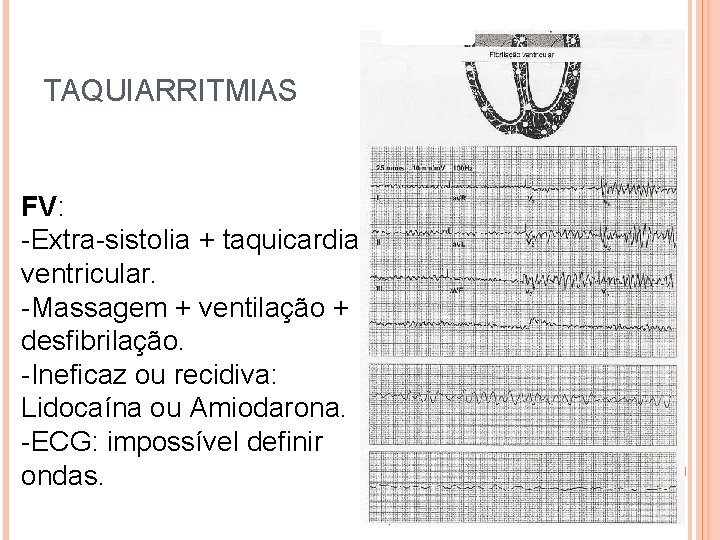 TAQUIARRITMIAS FV: -Extra-sistolia + taquicardia ventricular. -Massagem + ventilação + desfibrilação. -Ineficaz ou recidiva: